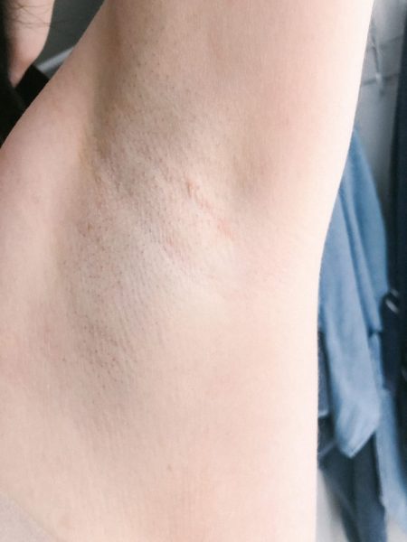 Underarm Laser Hair Removal - Your Questions Answered!